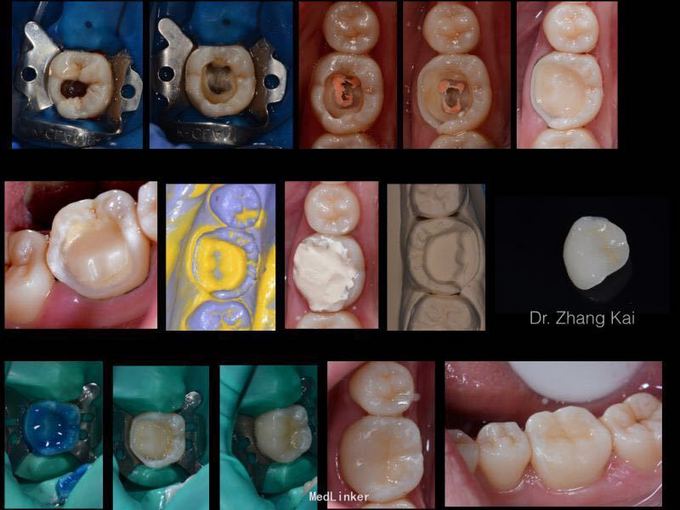 牙髓炎根管治疗后嵌体修复