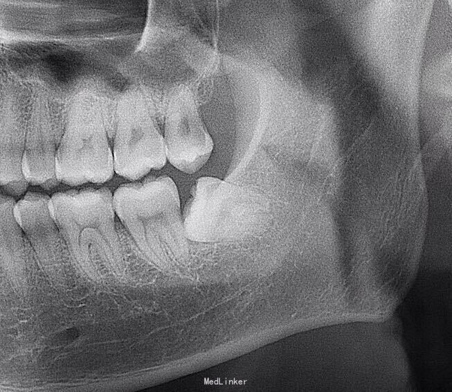 一例近中阻生齿拔除-医联