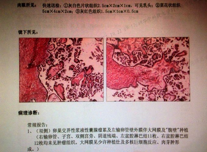 卵巢交界性浆液性囊腺瘤