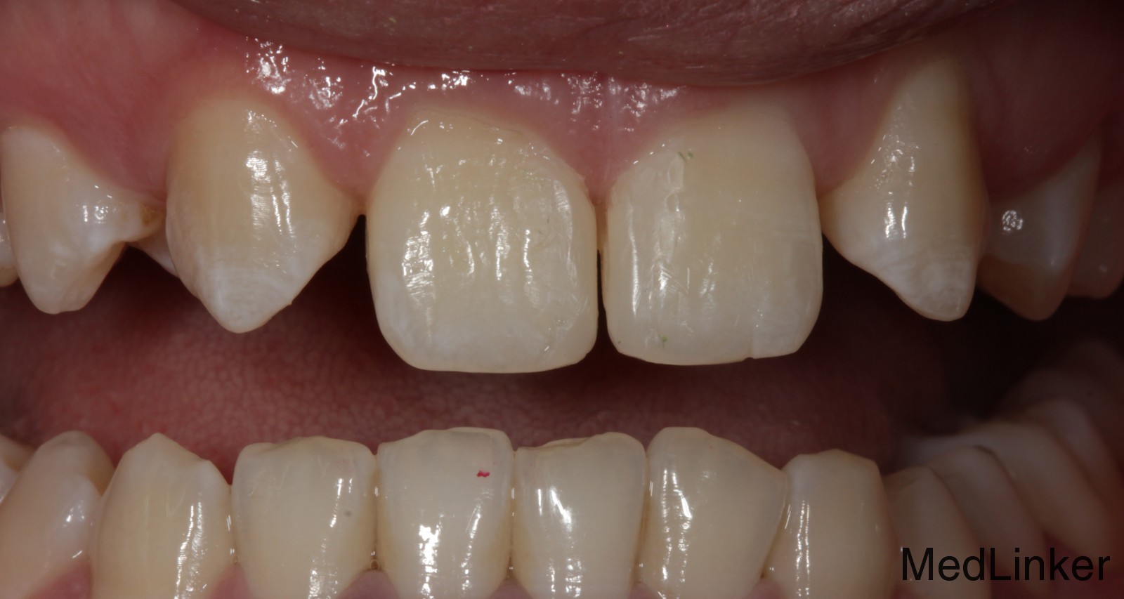 为什么牙齿正畸有的人会牙龈增生，有的人会牙龈萎缩？如果有萎缩（黑三角？）有什么好办法缓解吗？ - 知乎