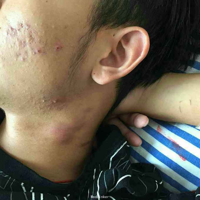 反复淋巴结肿大2年