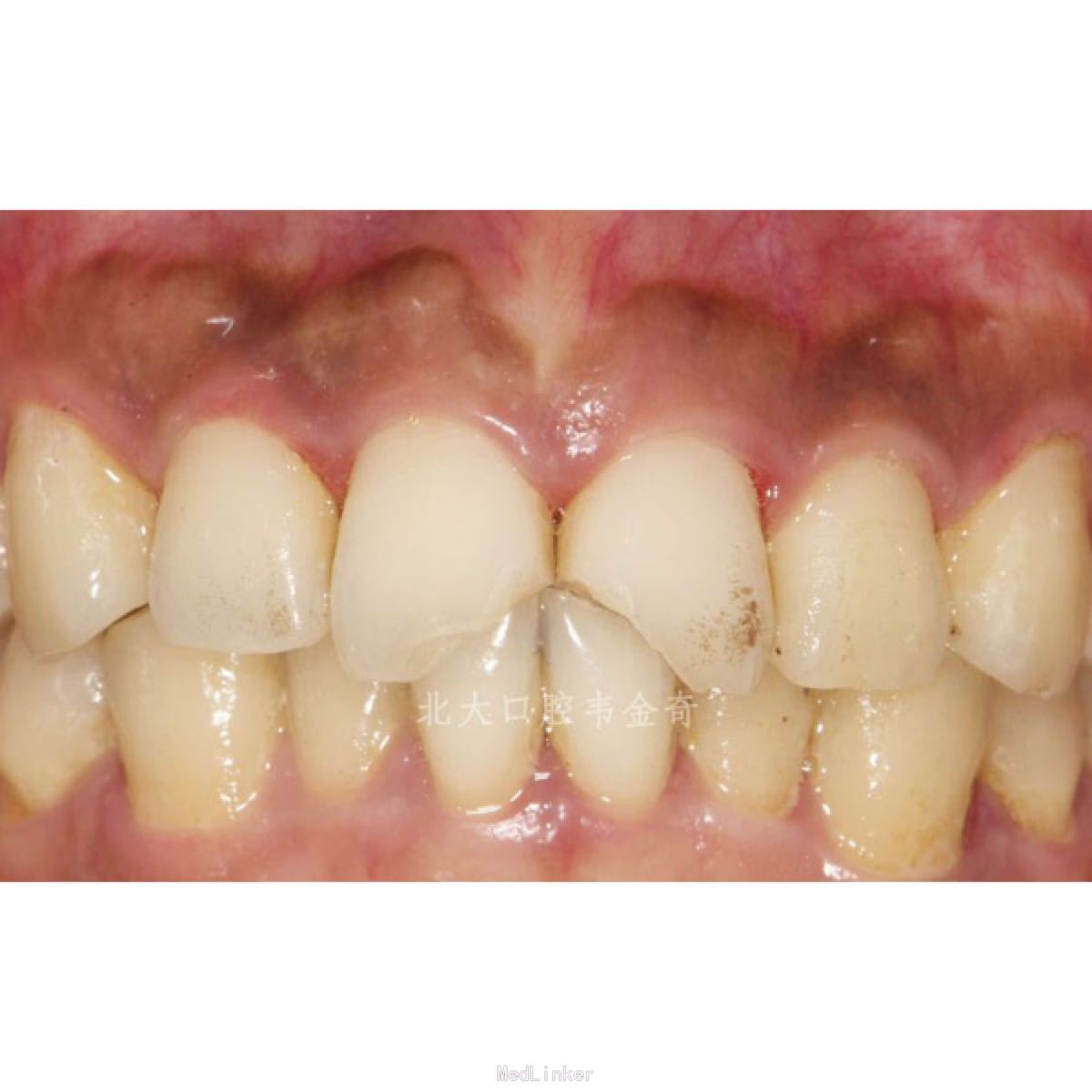 牙外伤的固定技术和牙髓治疗_侵权