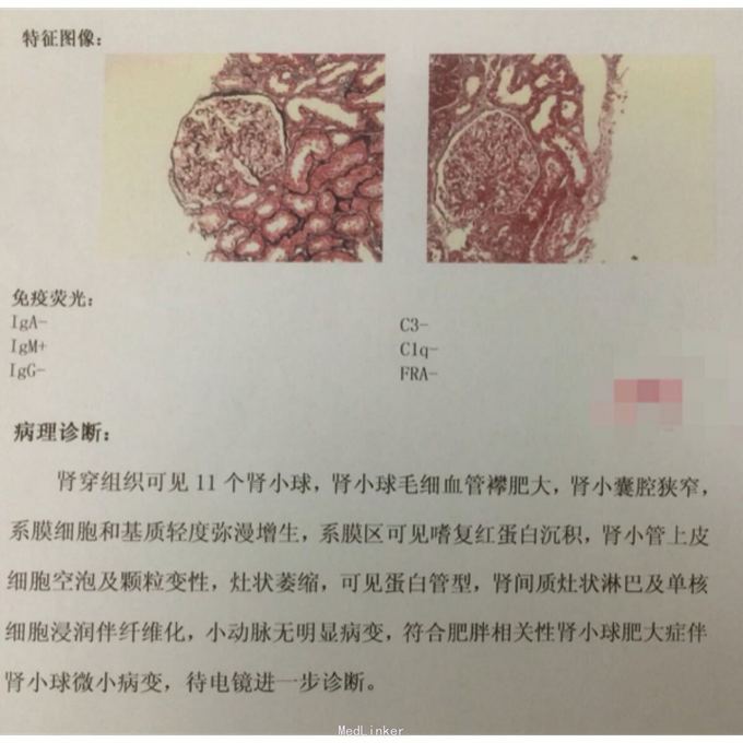 典型肾综微小病变肾病1例