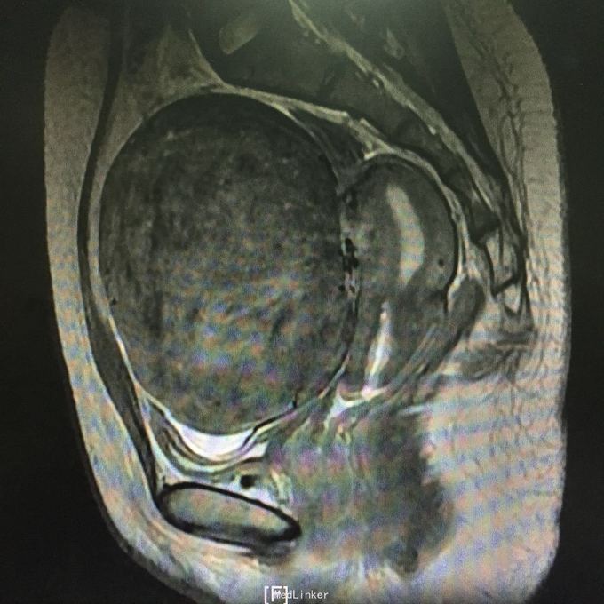 巨大浆膜下子宫肌瘤1例