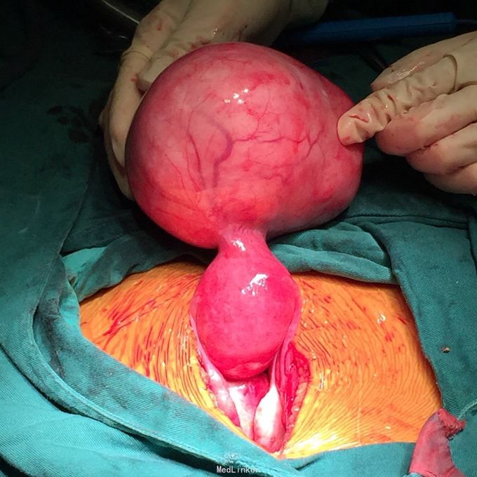 巨大浆膜下子宫肌瘤1例