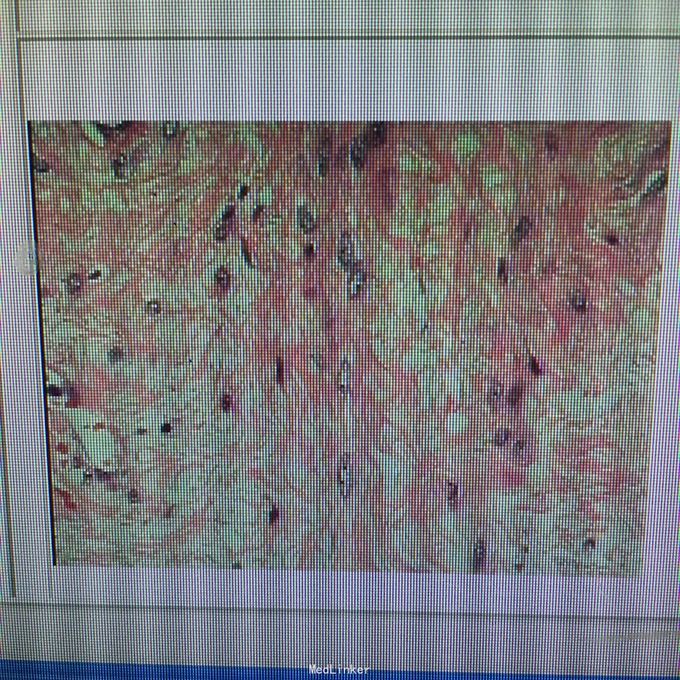 巨大浆膜下子宫肌瘤1例