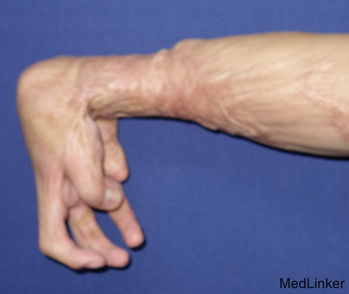 右手瘢痕挛缩畸形1例