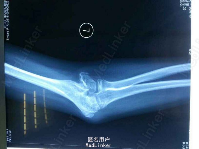 今来院就诊,拍片示左肘外翻畸形.