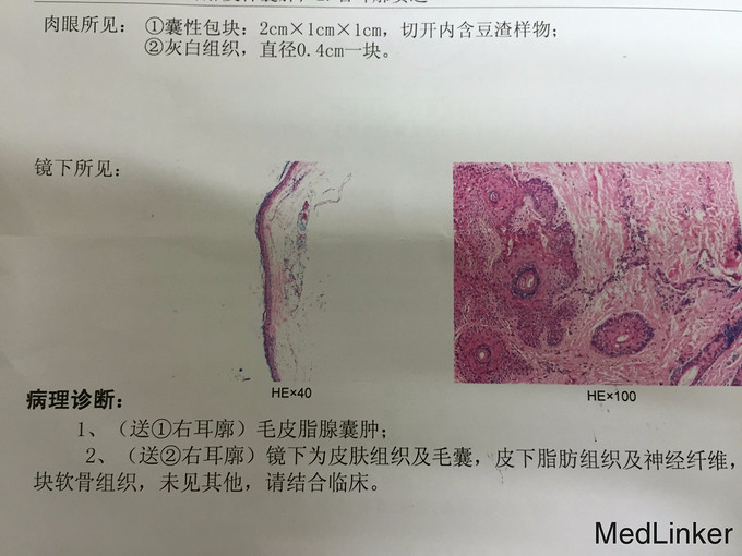 耳朵皮脂腺囊肿一例