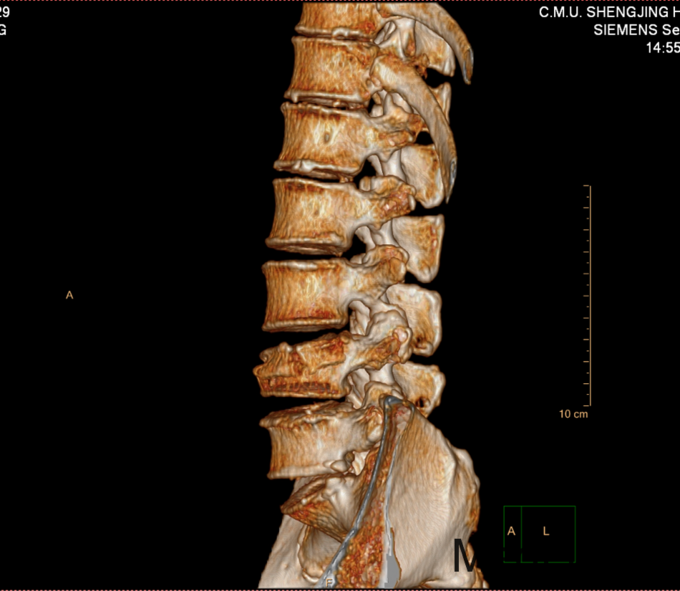 腰4椎体骨折