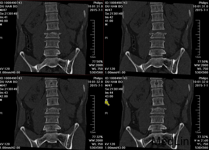 腰椎骨折,腰3,4,5椎体骨折,腰3椎体滑脱,腰3横突骨折,脊髓损伤,双下肢