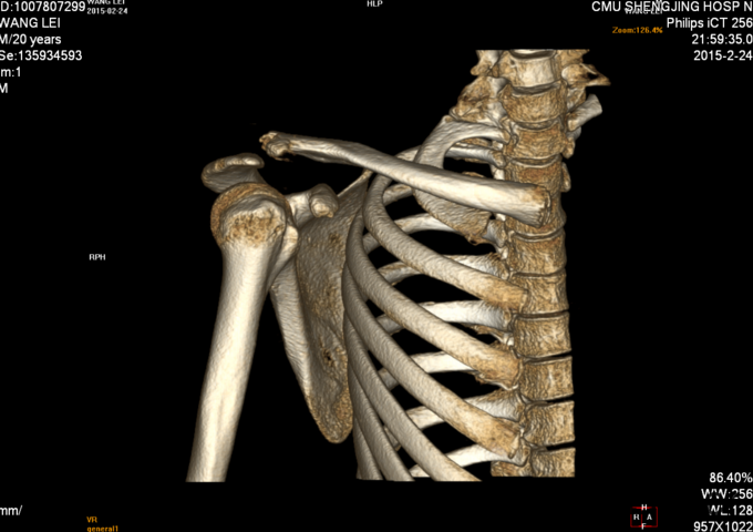 右锁骨骨折(allman 2型);右肩锁关节脱位(?