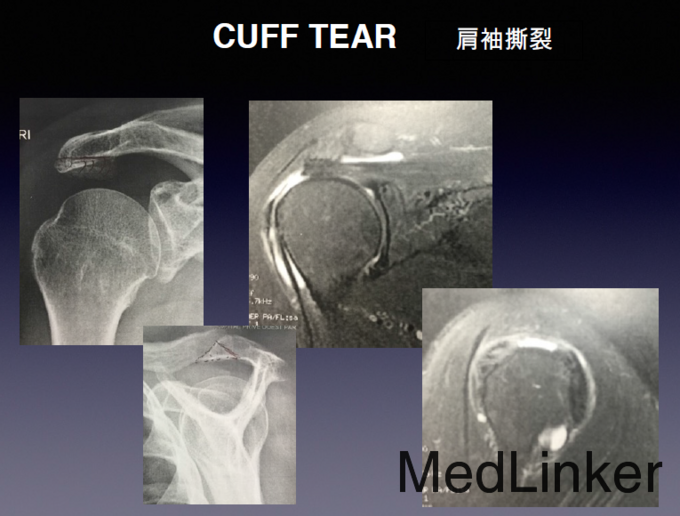 肩袖撕裂的诊断及治疗