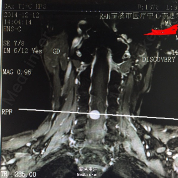 h0ffman征(一),babinskis征(一),膝反射未亢,肌张力未亢. 颈椎mri