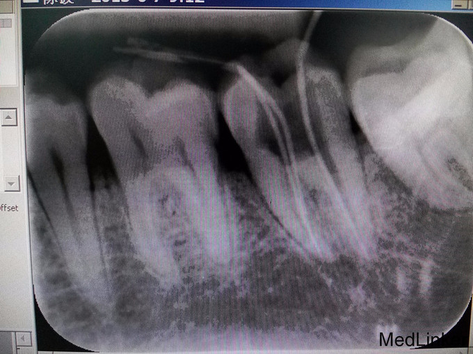 左下后牙根管治疗