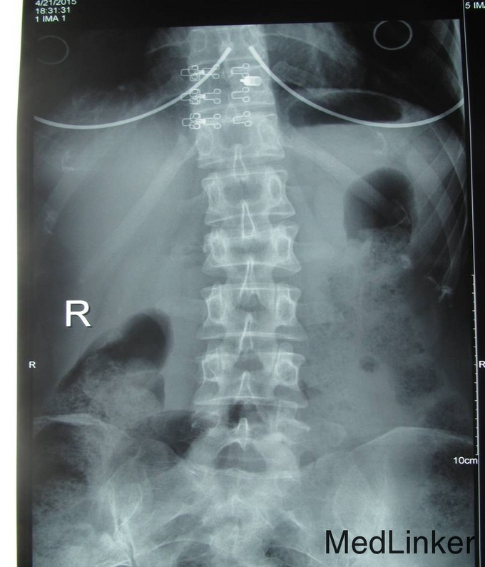 腰2椎体压缩性骨折