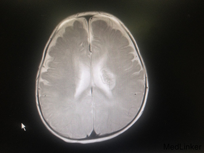 头颅mri(如下图):左侧放射冠-基底节区异常信号灶,多考虑亚急性期