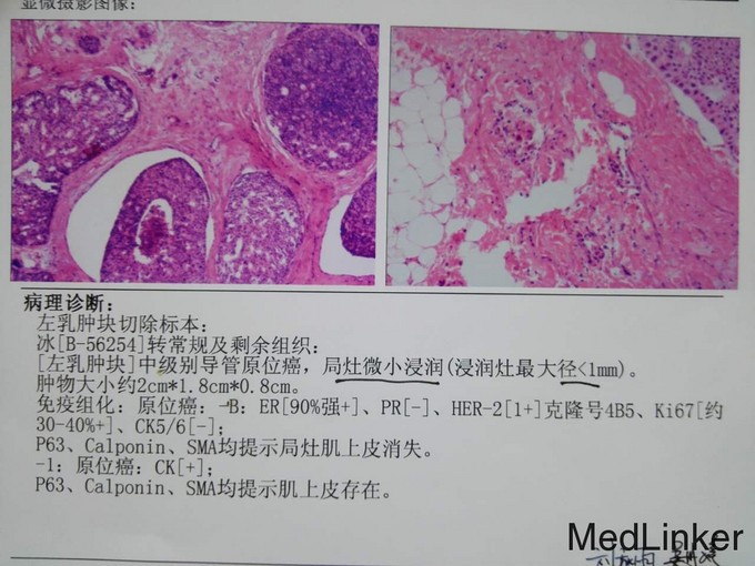 乳腺导管原位癌伴局灶微小浸润一例