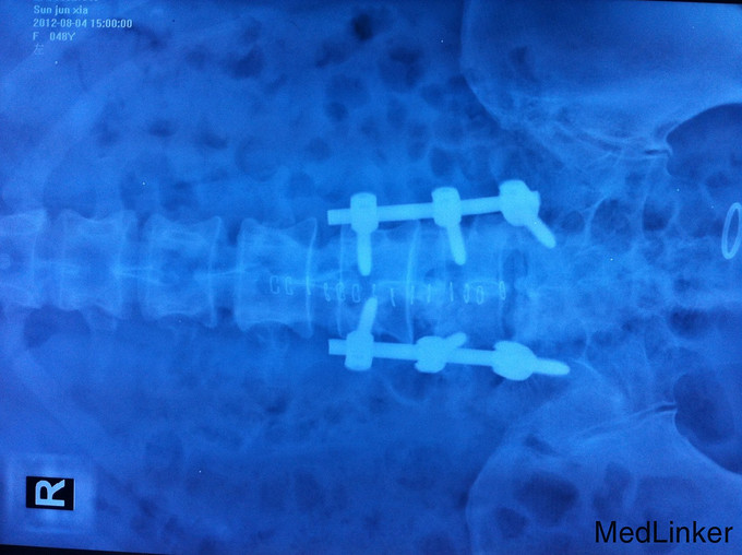 腰45腰5骶1椎间融合内固定术病例分享
