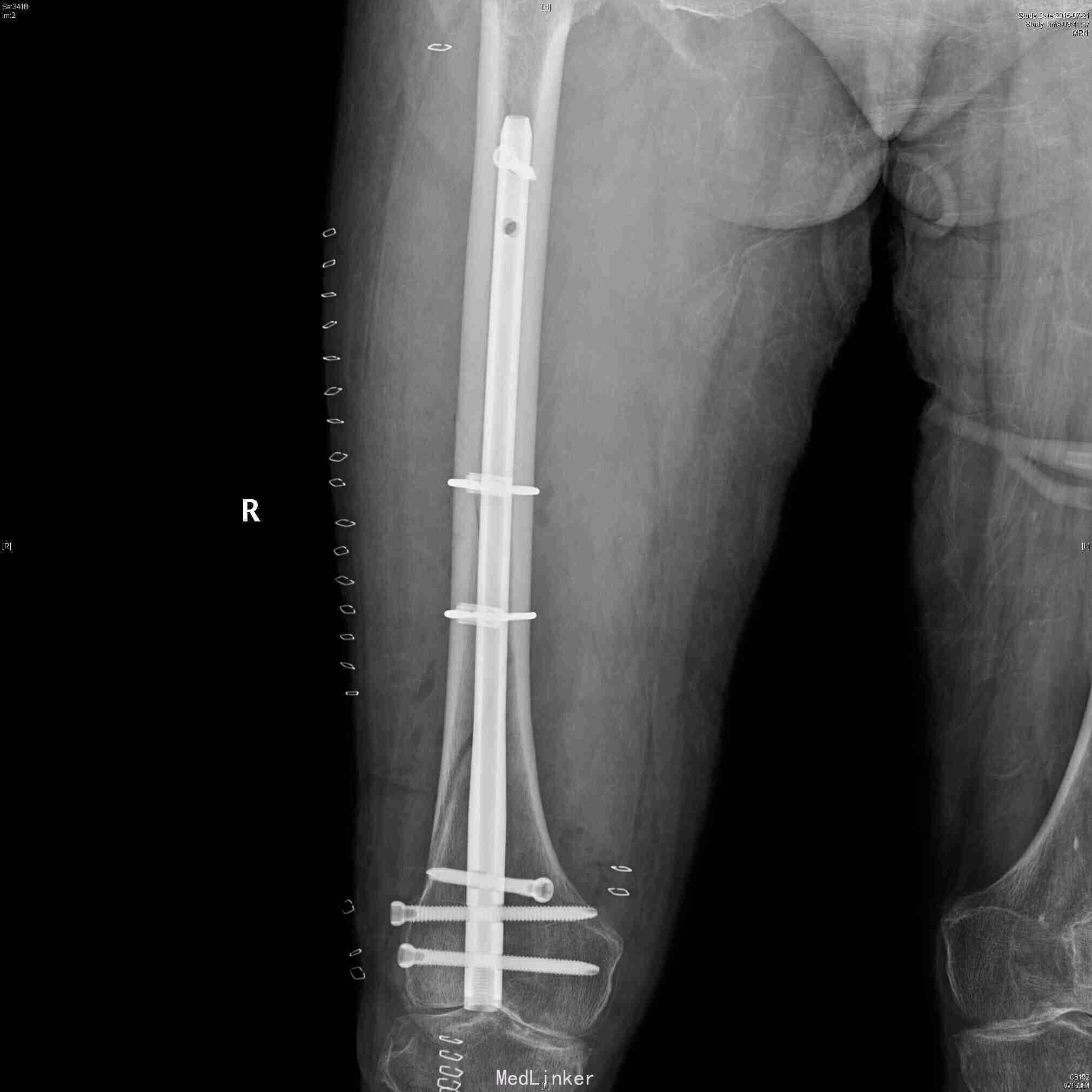 一例股骨干中下段螺旋骨折的倒打髓内钉治疗