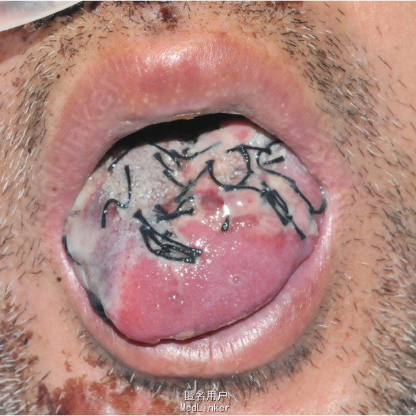 舌部损伤治疗原则:  保持长度,纵形缝合  分别缝合,以舌为主  粗针粗