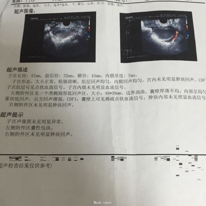 巨大黄体血肿1例