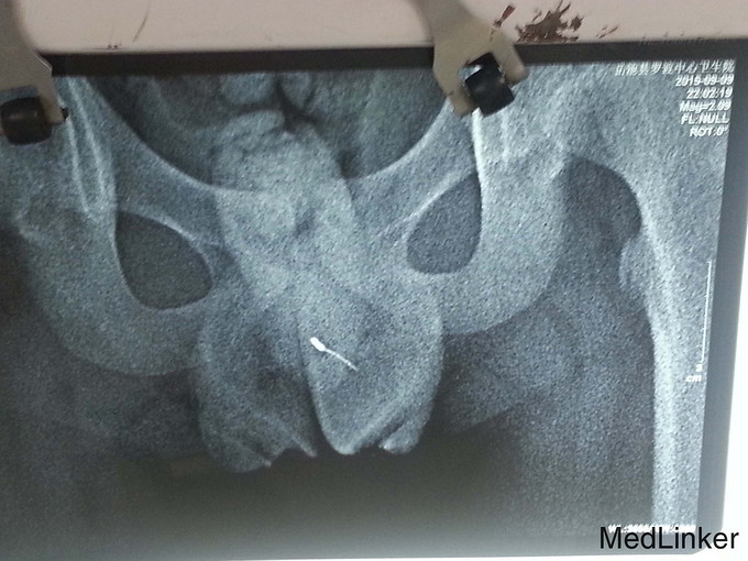 异物癖一针灸用针放入尿道致尿道阴囊损伤一例报道