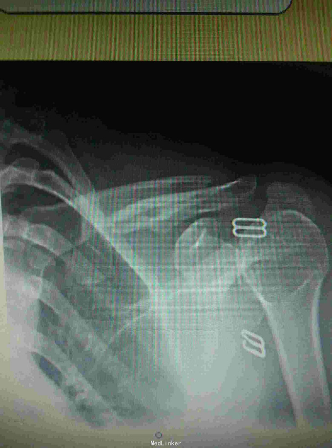 锁骨骨折闭合复位钢针固定术