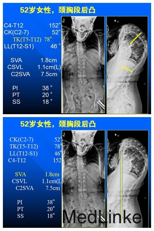 重度颈椎后凸畸形