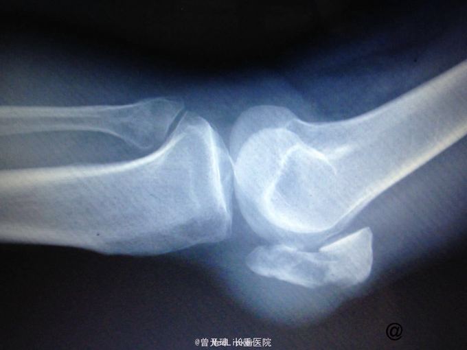主诉 病史 外伤后左膝疼痛不适,屈伸不能.x片示左髌骨骨折