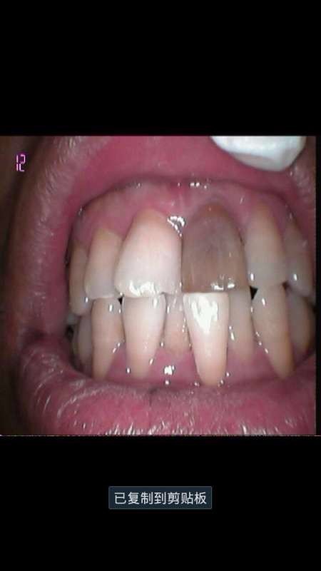 主诉 病史 左上1,牙髓坏死,牙齿变色,根管治疗后,烤瓷冠修复