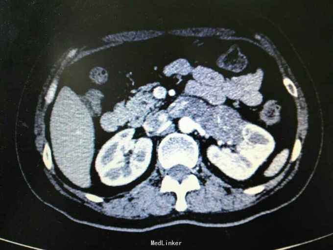 左肾门占位:癌栓?血栓?
