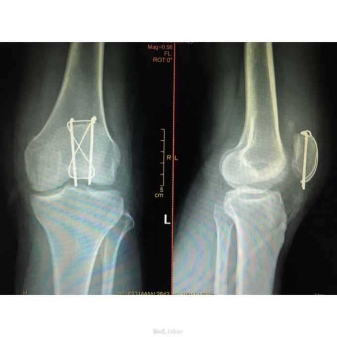 髌骨骨折切开复位克氏针张力带内固定