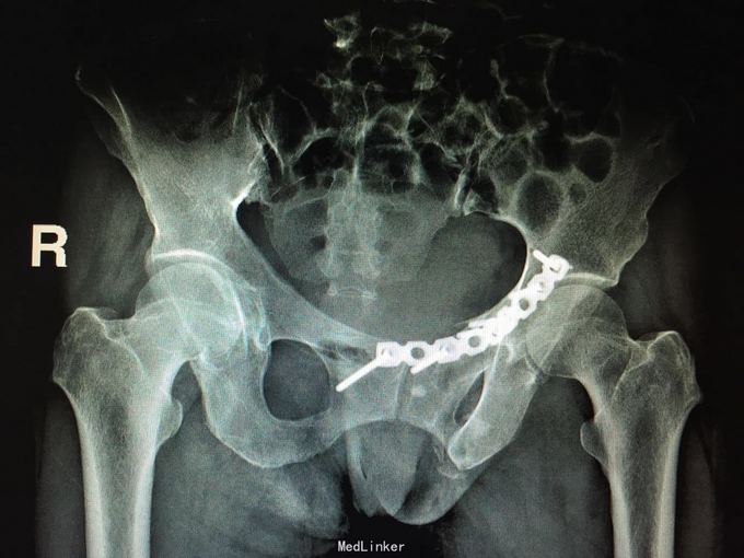 骨盆骨折切开复位钢板螺钉内固定