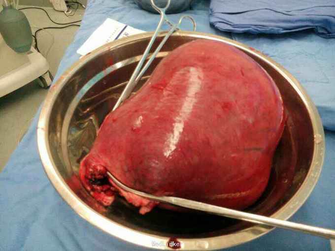 巨大子宫肌瘤行全子宫切除术一例