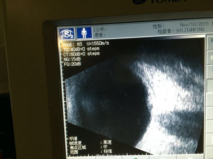 眼底出血一例医联