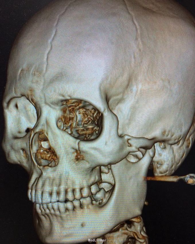 查体 辅查 左面部凹限,左眶下区麻朩,ct示左颧骨颧弓骨折.张口度2.