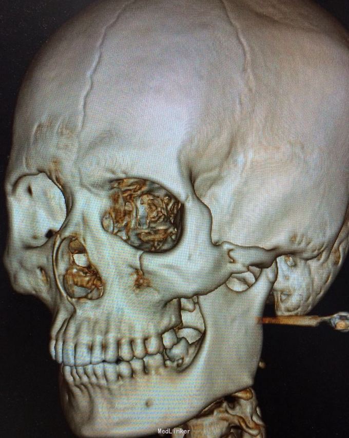 左颧骨欢弓骨折