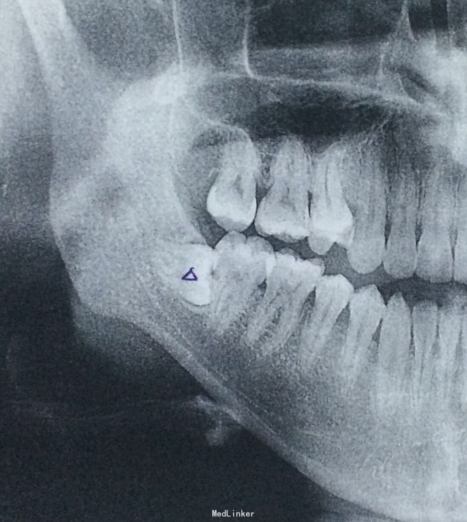 主诉 病史 右下埋伏阻生齿,因正颌需要术前拔牙.