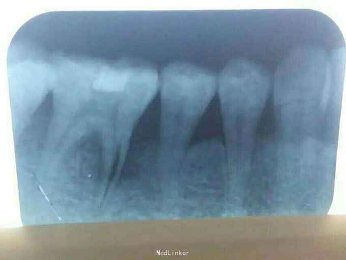 后牙根纵裂后行半切术病例分析
