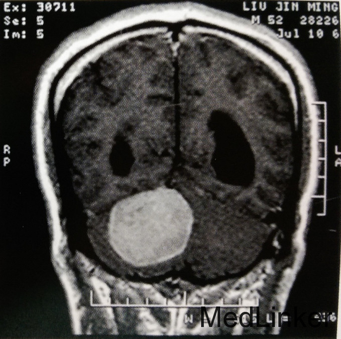 小脑幕脑膜瘤一例