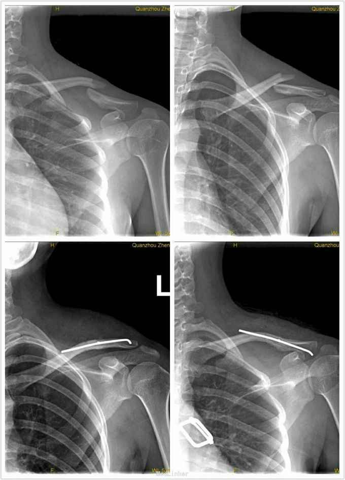 锁骨骨折闭合穿针并发金属碎屑异物反应