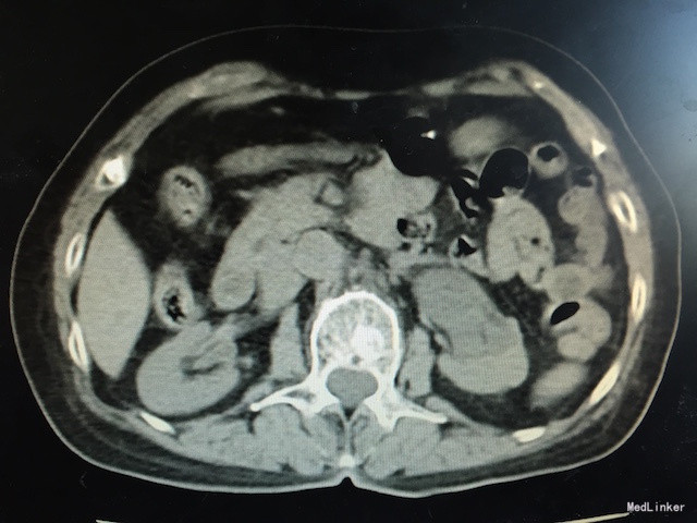 辅助检查:泌尿系ct如下图所示:左侧输尿管下段可见软组织密度影,其上