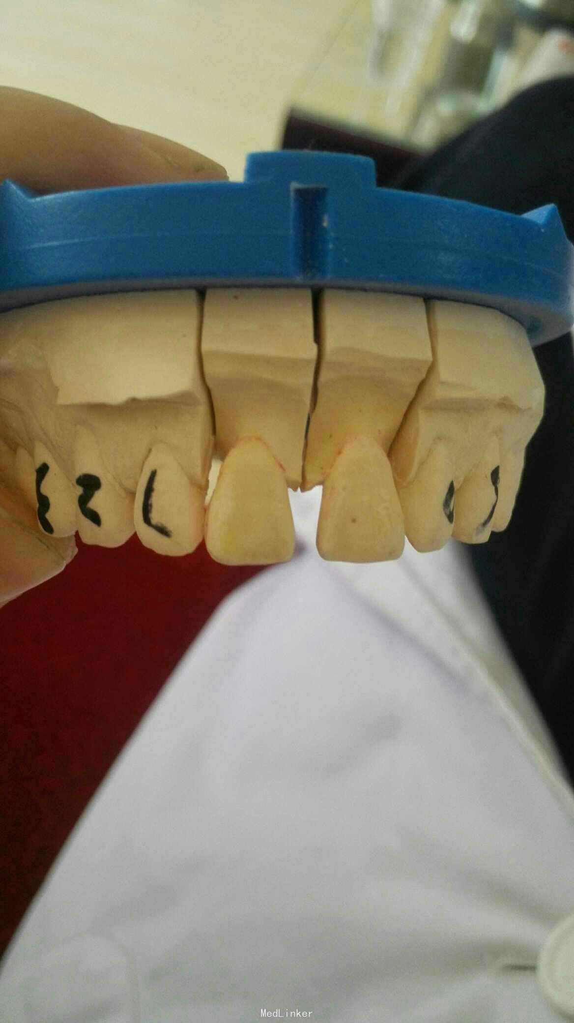 骨性反颌（轻微地包天）-对刃、中线不齐、牙齿缝隙大-26岁男-正畸记录 - 知乎
