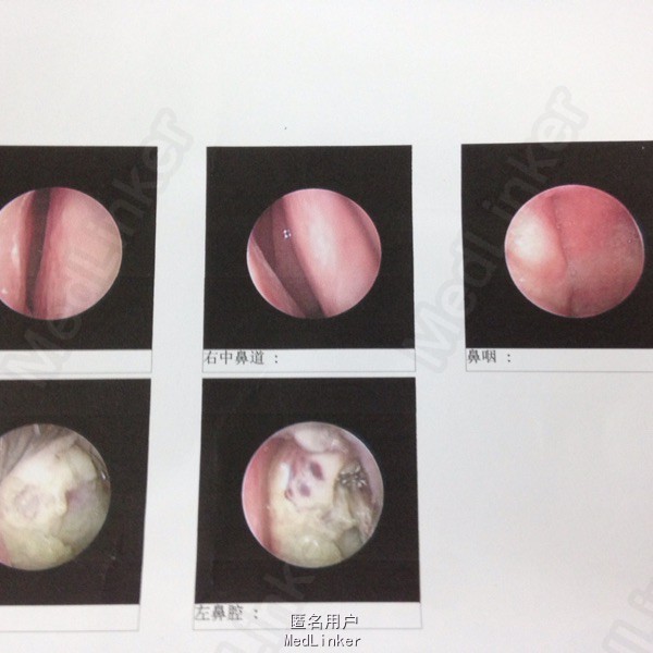左侧鼻腔肿物