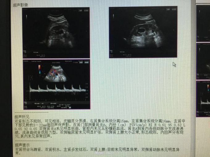 马蹄肾合并肾结石,积水