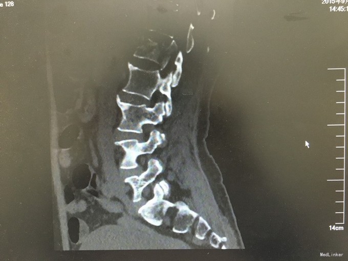 坠落伤l1椎体骨折脊髓损伤