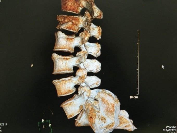 坠落伤l1椎体骨折脊髓损伤