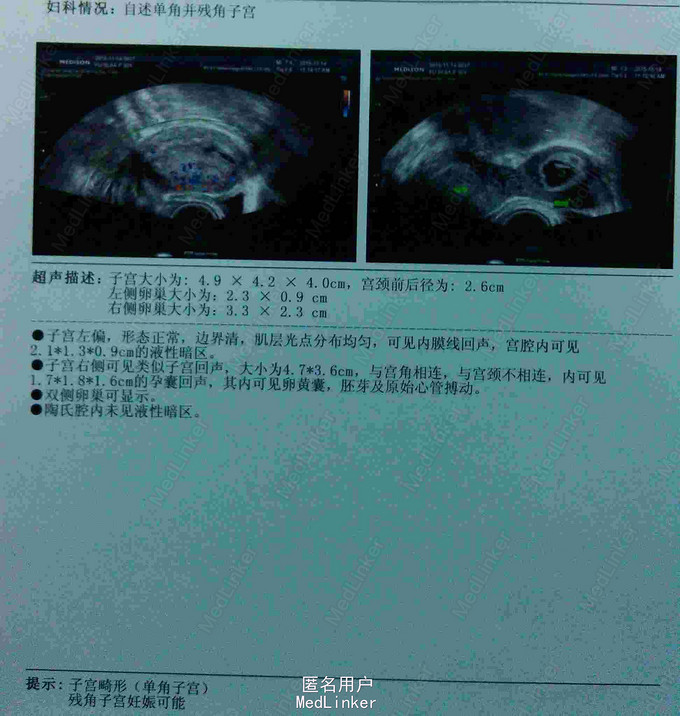 残角子宫妊娠合并子宫内膜异位