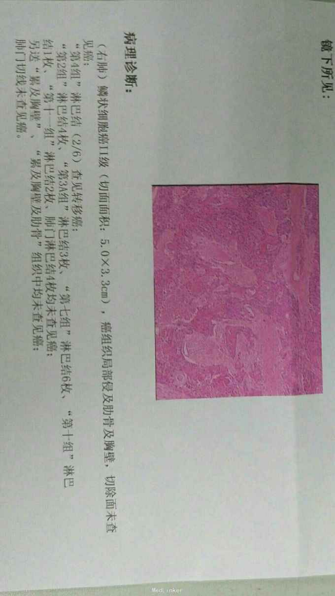 右肺鳞癌累及肋骨病例一枚